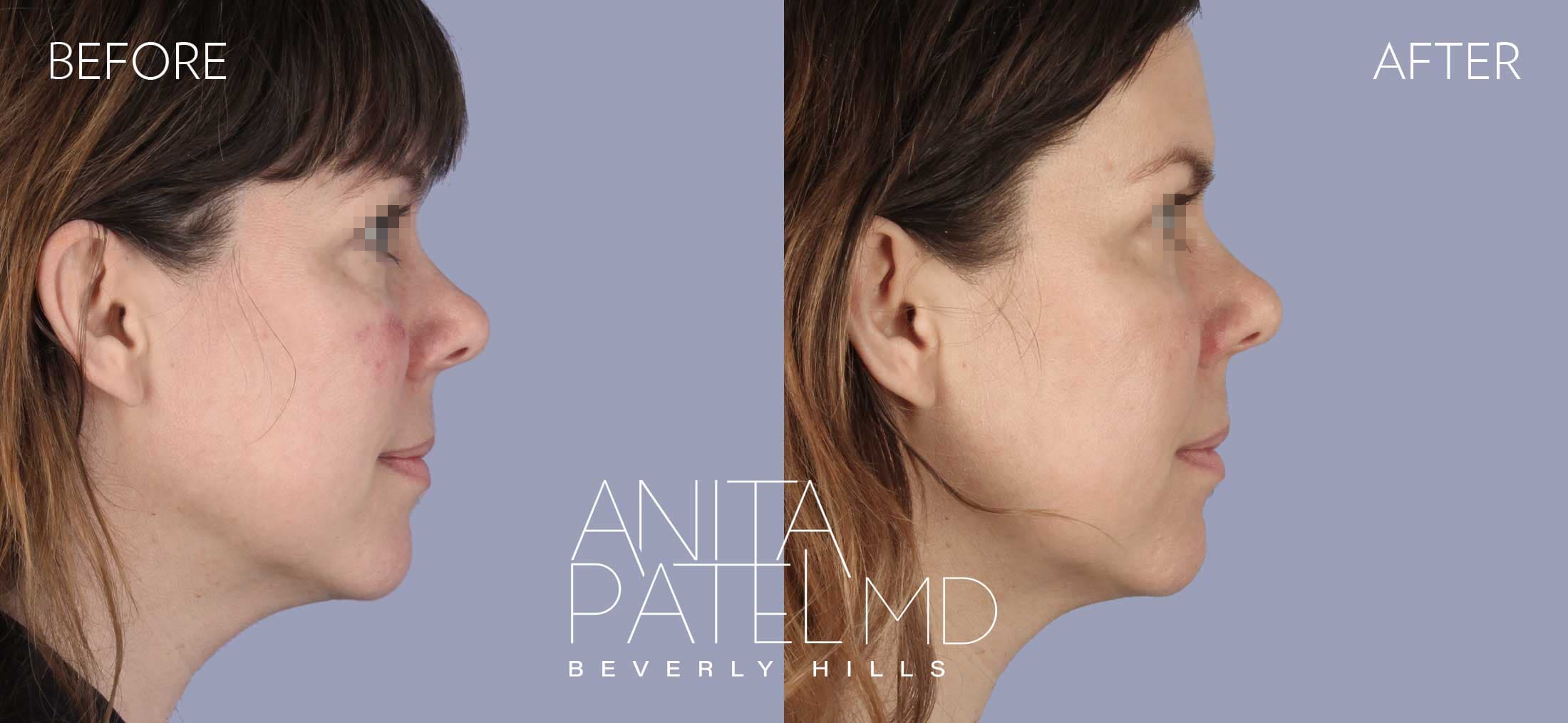 Skin Resurfacing before and after — Patient 1, photo 3 of 5 — Dr. Anita Patel, MD, FACS, Beverly Hills