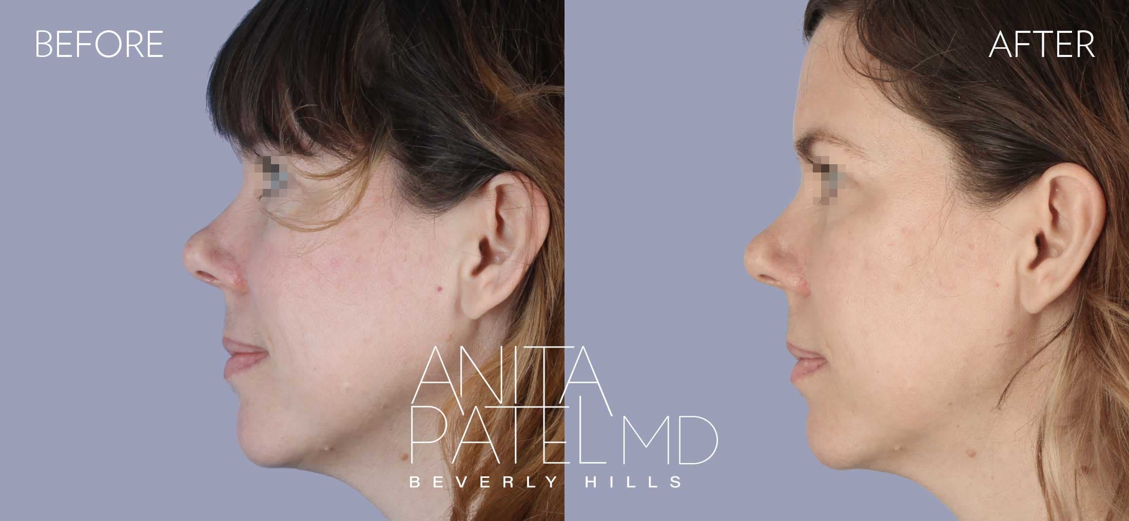 Skin Resurfacing before and after — Patient 1, photo 4 of 5 — Dr. Anita Patel, MD, FACS, Beverly Hills