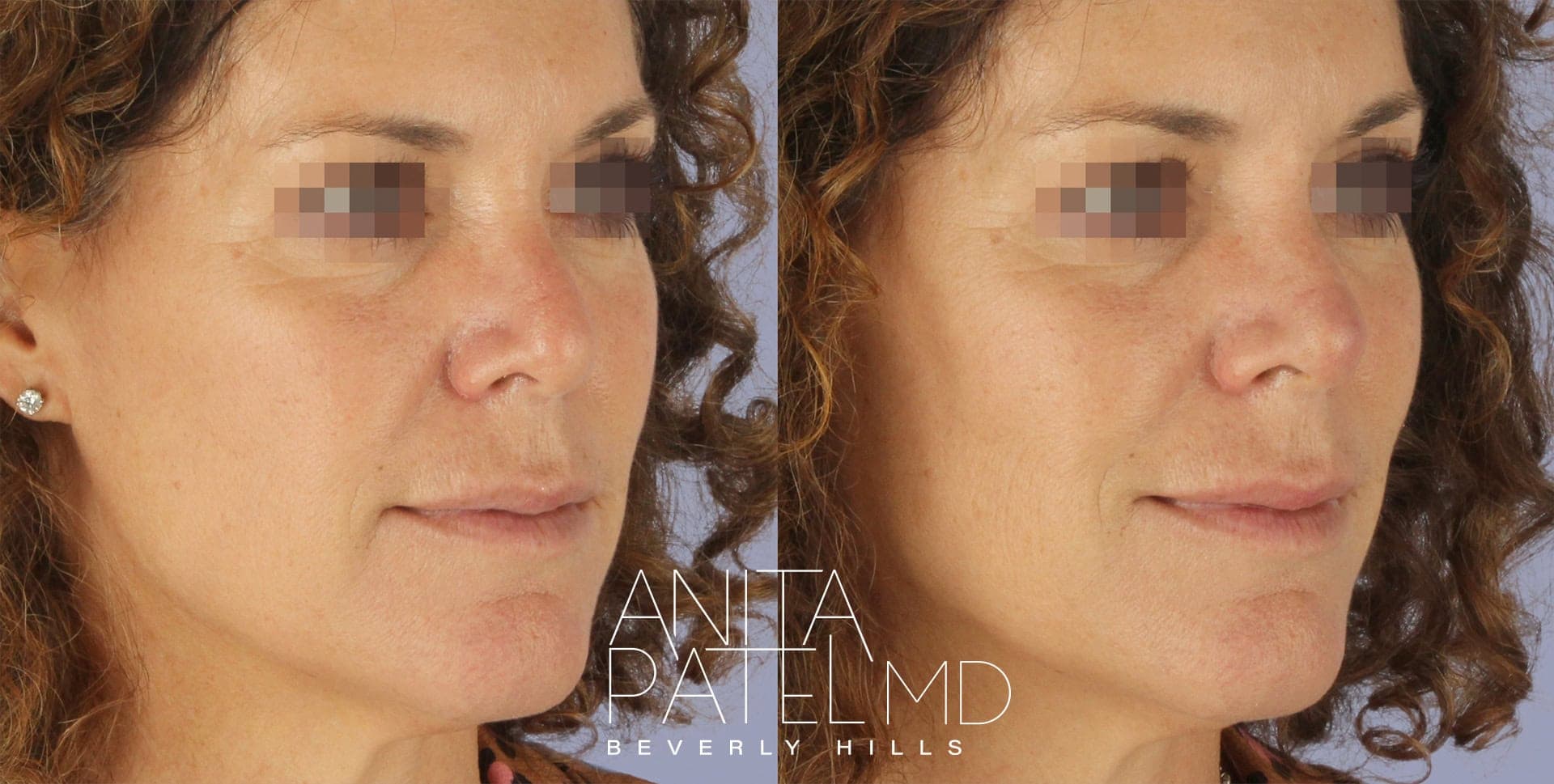 Threadlift before and after — Patient 1 — Dr. Anita Patel, MD, FACS, Beverly Hills