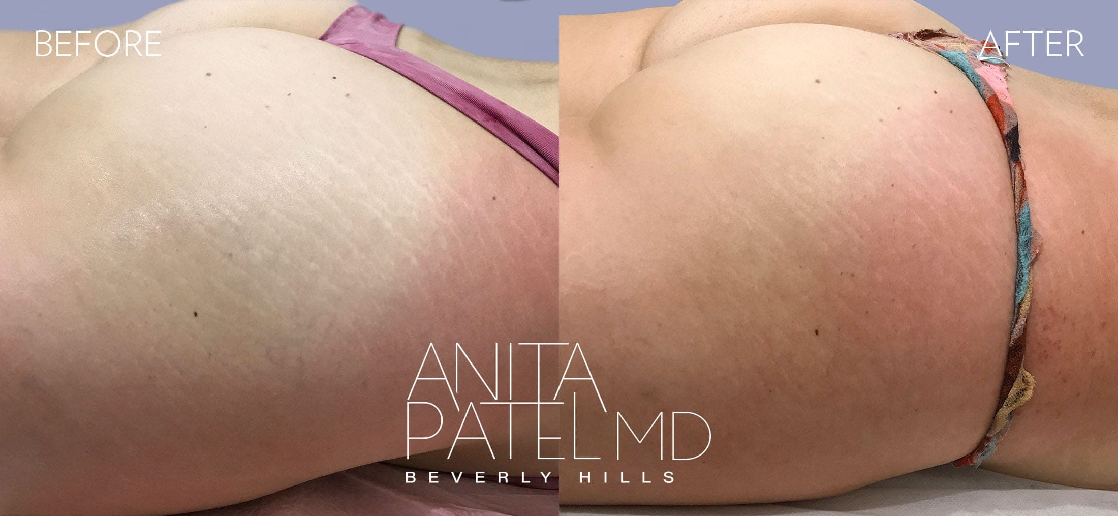 RF Skin Resurfacing before and after — Dr. Anita Patel, Beverly Hills