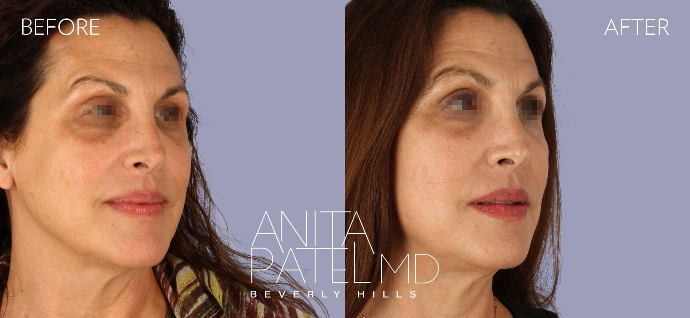 Threadlift before and after — Patient 3, photo 2 of 5 — Dr. Anita Patel, MD, FACS, Beverly Hills
