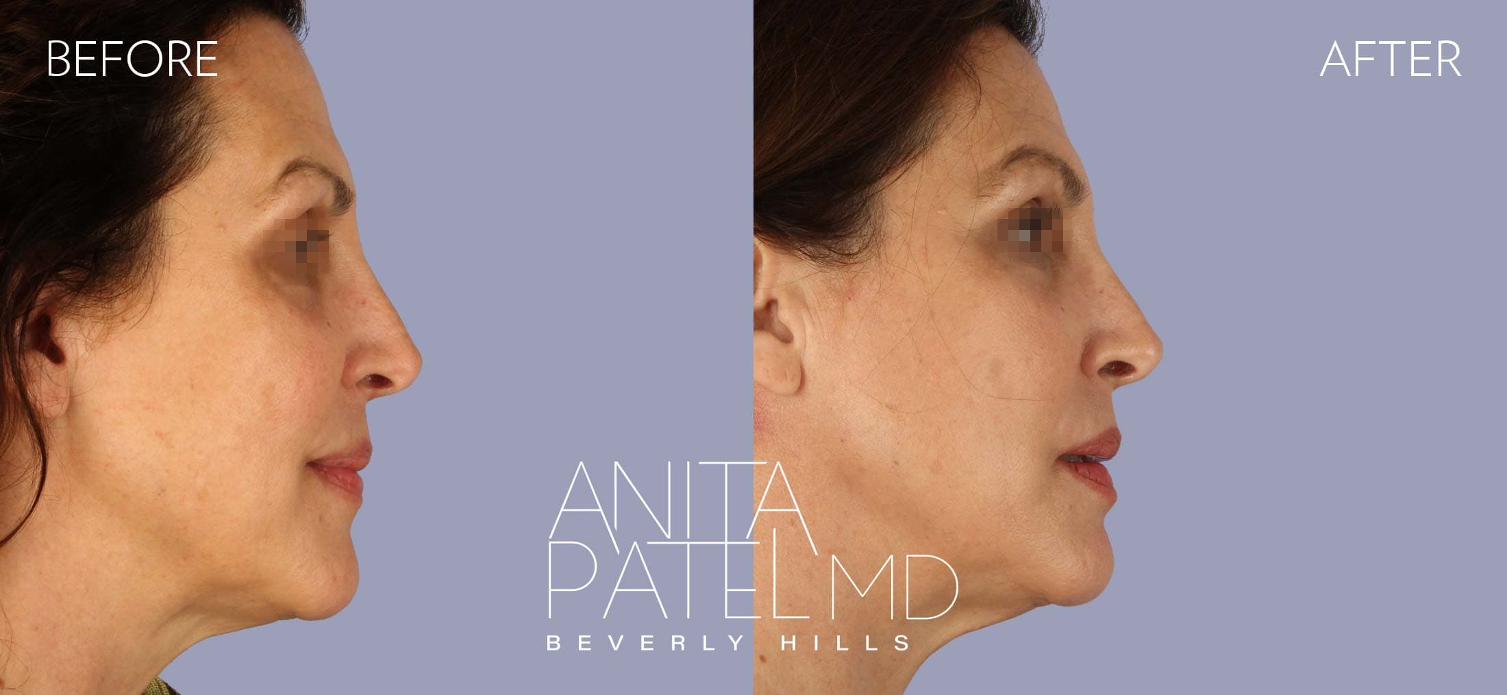 Threadlift before and after — Patient 3, photo 3 of 5 — Dr. Anita Patel, MD, FACS, Beverly Hills