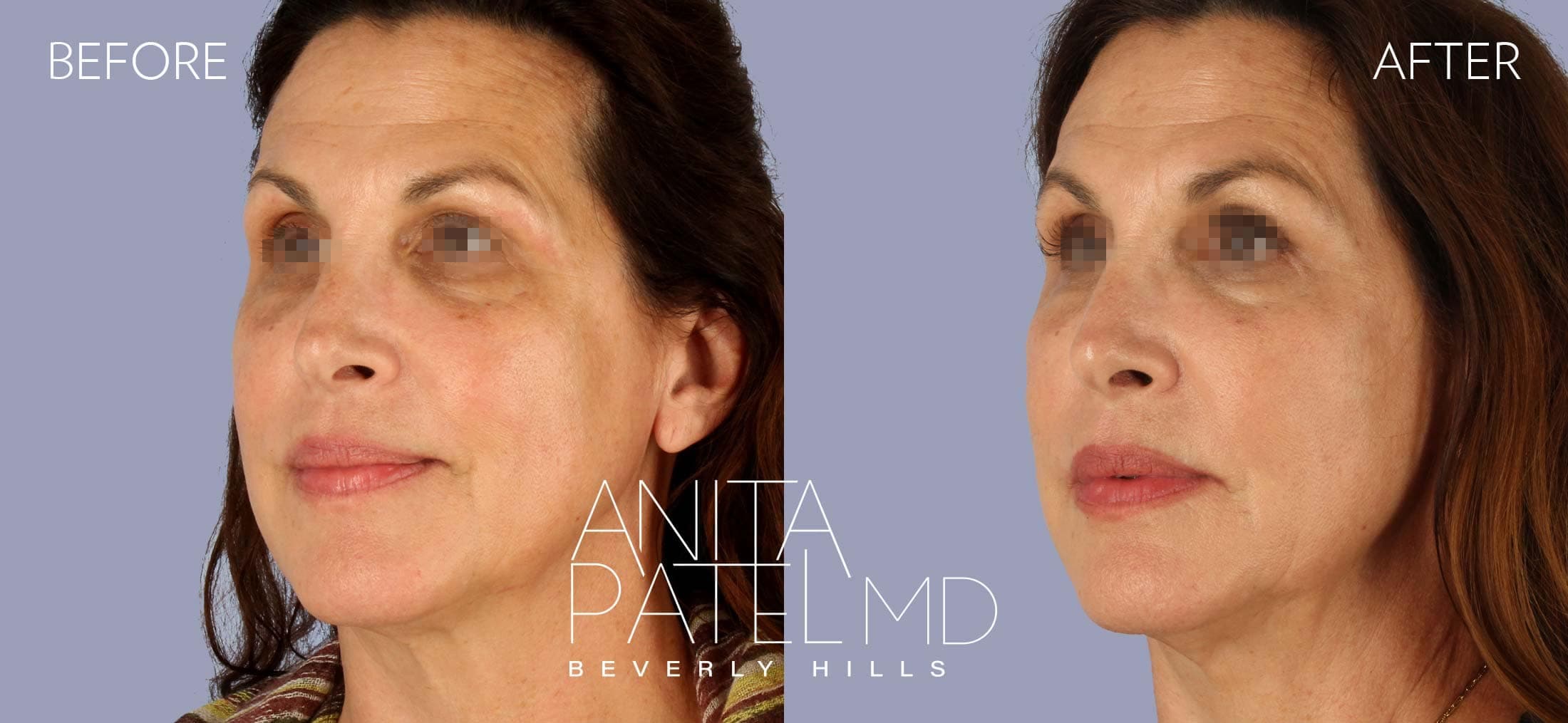 Threadlift before and after — Patient 3, photo 4 of 5 — Dr. Anita Patel, MD, FACS, Beverly Hills