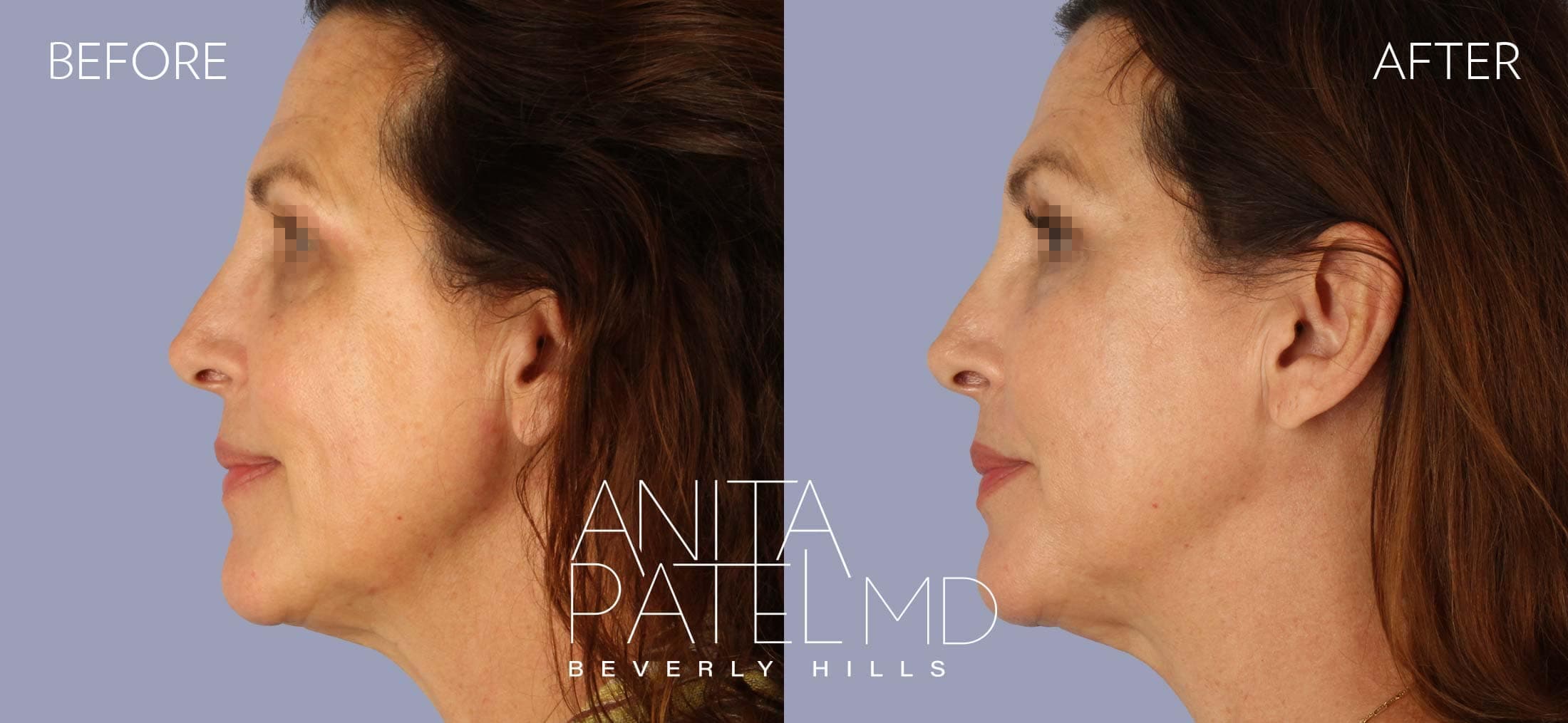 Threadlift before and after — Patient 3, photo 5 of 5 — Dr. Anita Patel, MD, FACS, Beverly Hills
