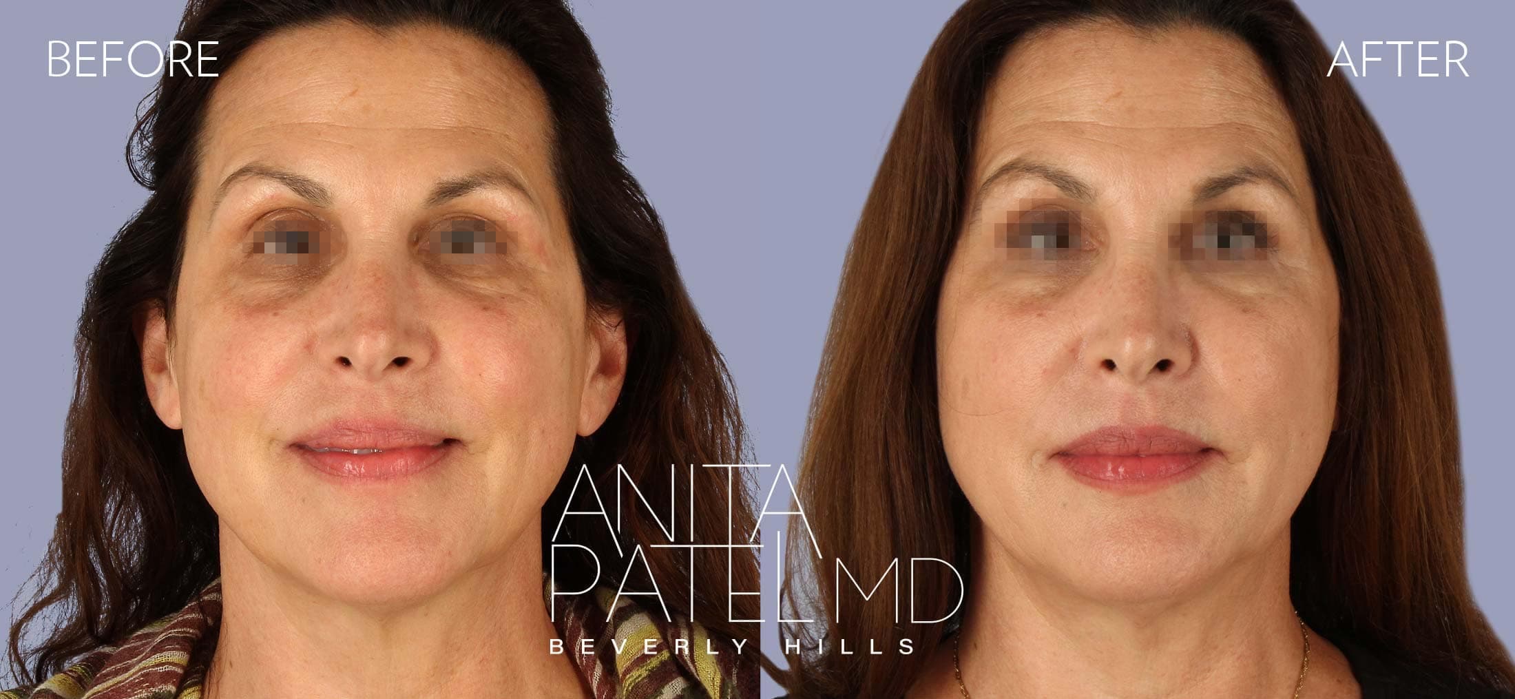 Threadlift before and after — Dr. Anita Patel, Beverly Hills