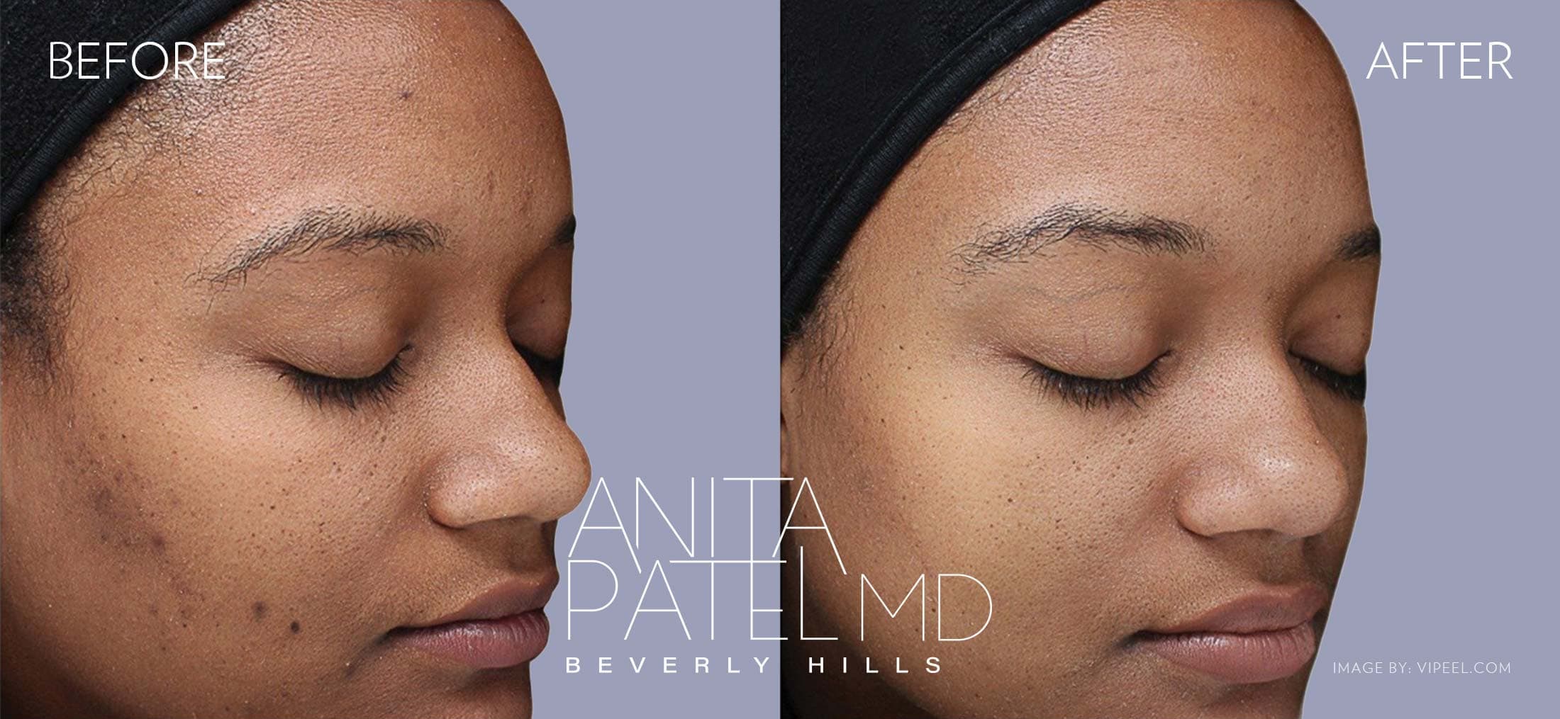 Skin Resurfacing before and after — Patient 5 — Dr. Anita Patel, MD, FACS, Beverly Hills