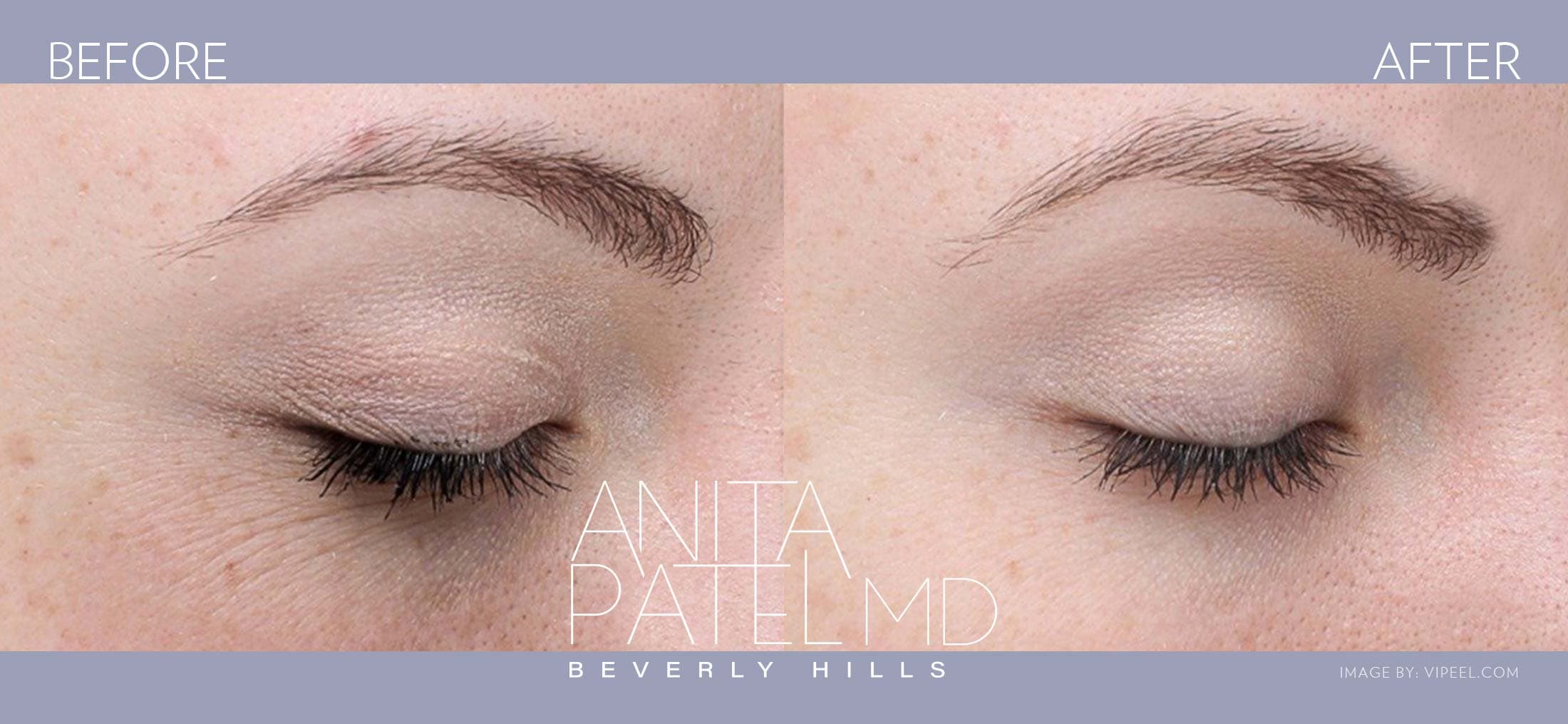Skin Resurfacing before and after — Patient 10 — Dr. Anita Patel, MD, FACS, Beverly Hills