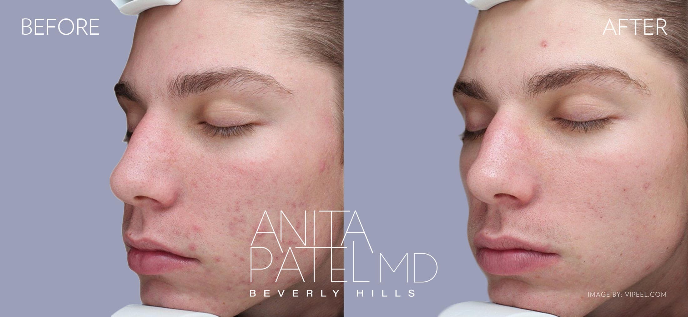 Skin Resurfacing before and after — Patient 9 — Dr. Anita Patel, MD, FACS, Beverly Hills