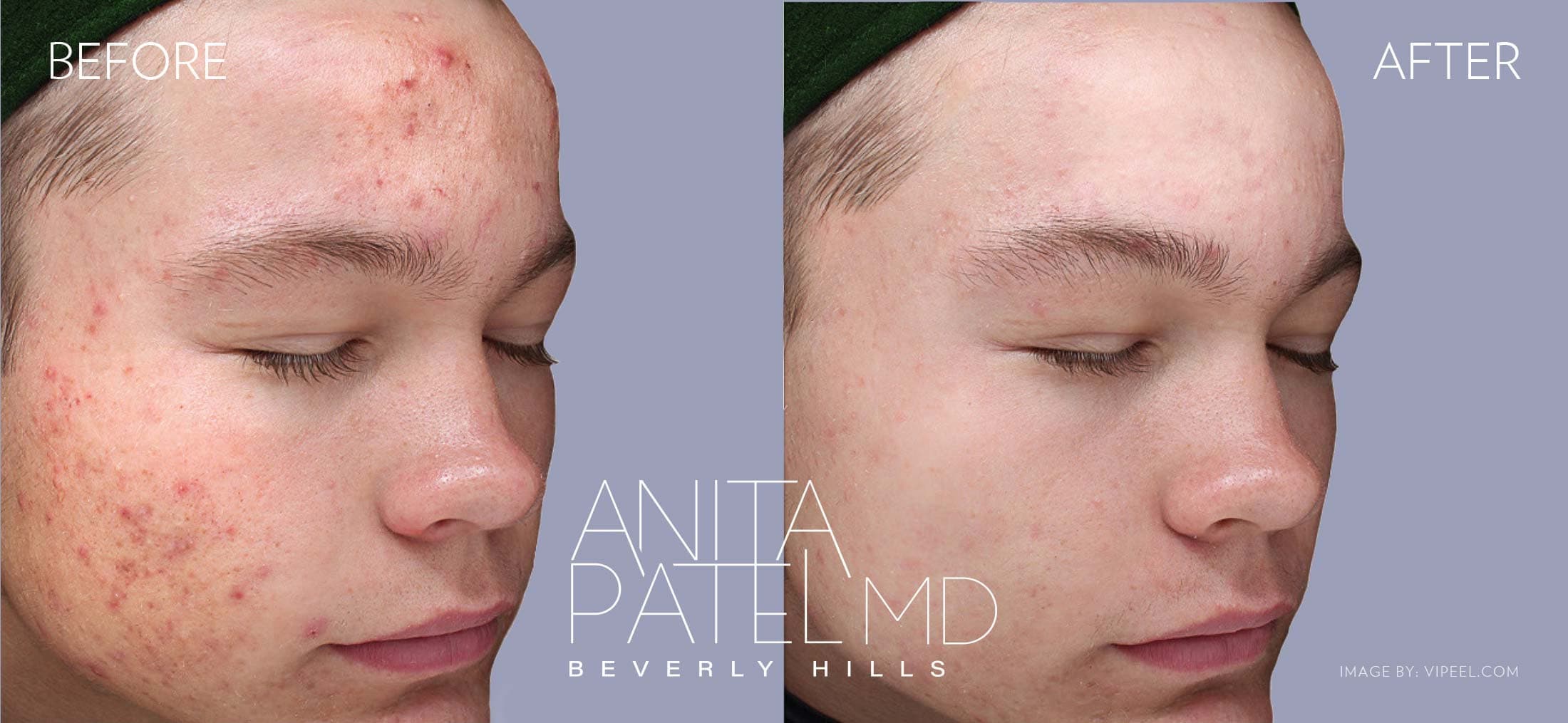 Skin Resurfacing before and after — Patient 3 — Dr. Anita Patel, MD, FACS, Beverly Hills