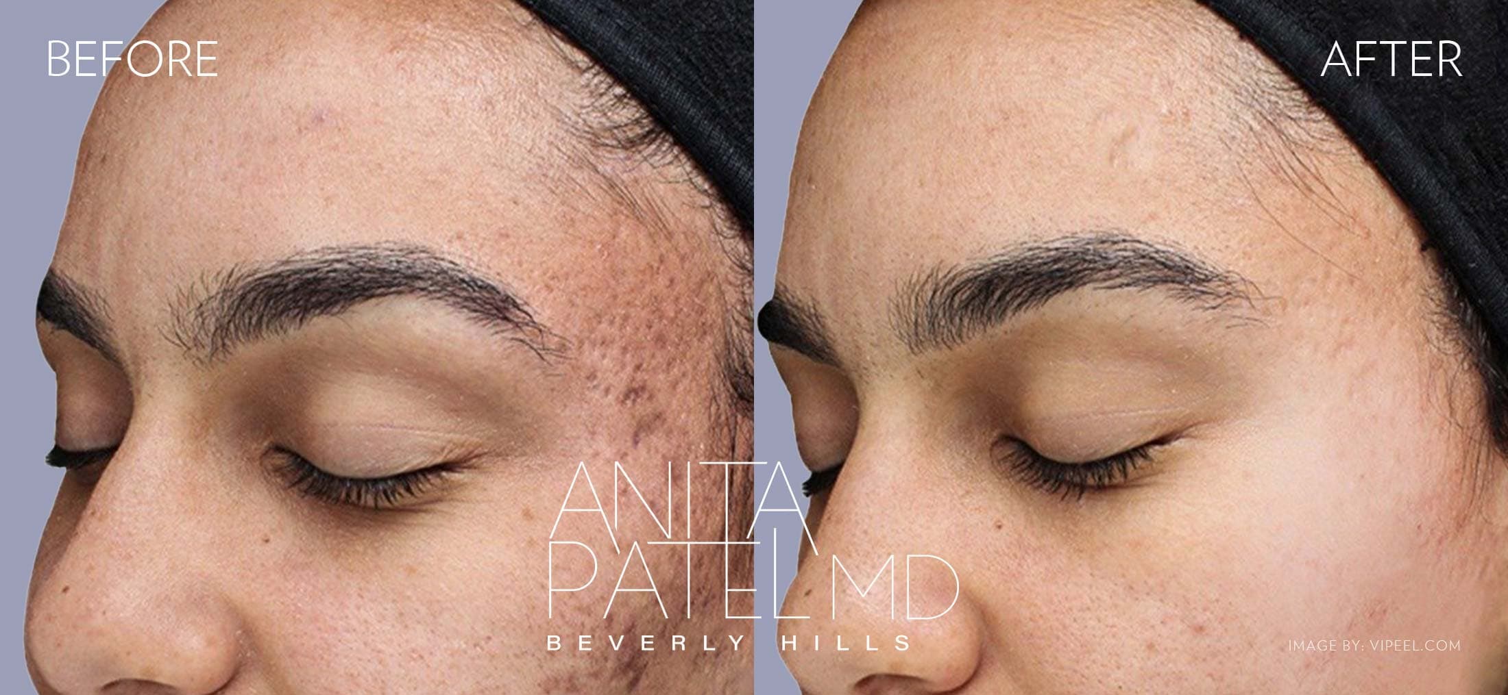 Skin Resurfacing before and after — Patient 6, photo 1 of 2 — Dr. Anita Patel, MD, FACS, Beverly Hills