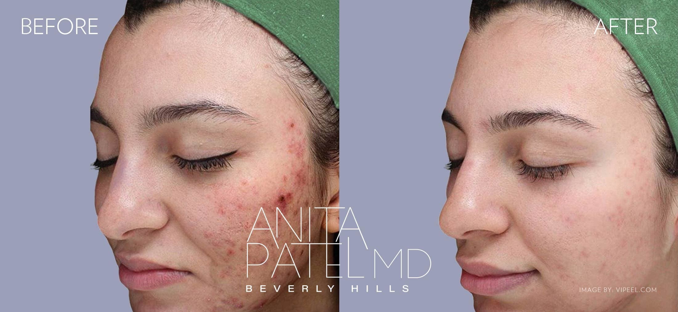 Skin Resurfacing before and after — Patient 6, photo 2 of 2 — Dr. Anita Patel, MD, FACS, Beverly Hills