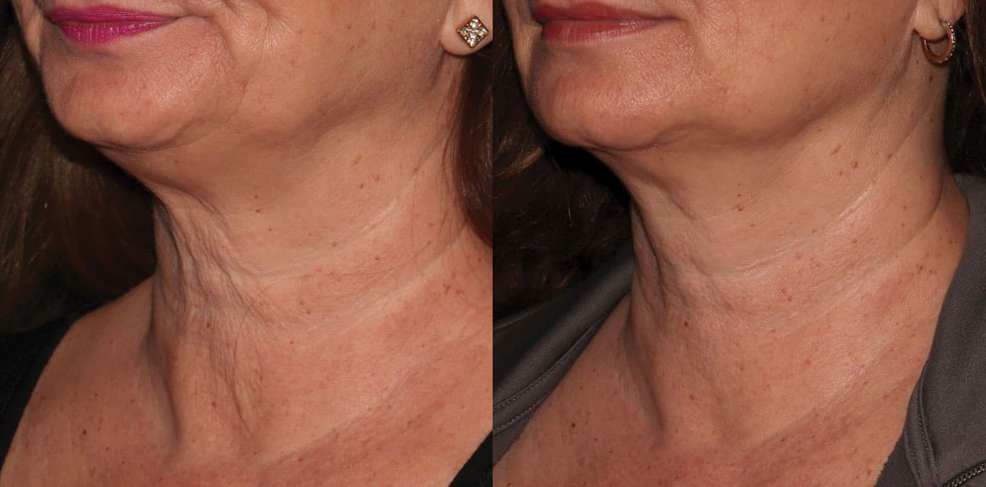 Sofwave™ before and after — Patient 10 — Dr. Anita Patel, MD, FACS, Beverly Hills