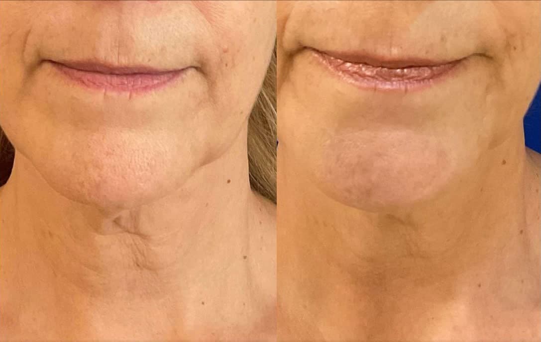 Sofwave™ before and after — Patient 9 — Dr. Anita Patel, MD, FACS, Beverly Hills