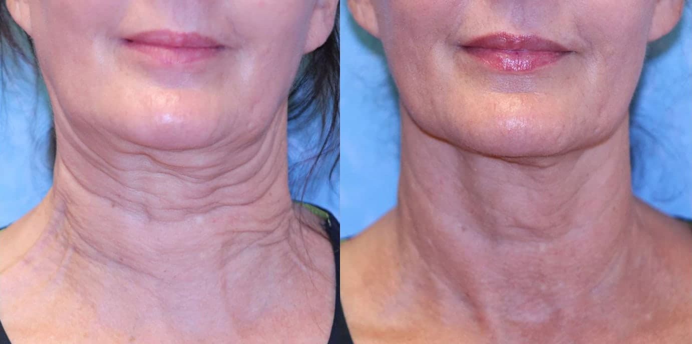 Sofwave™ before and after — Patient 8 — Dr. Anita Patel, MD, FACS, Beverly Hills