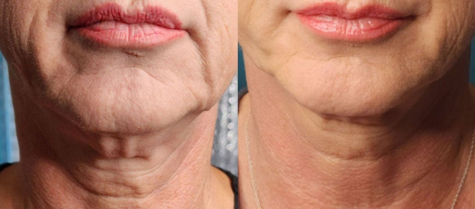Sofwave™ before and after — Patient 7 — Dr. Anita Patel, MD, FACS, Beverly Hills