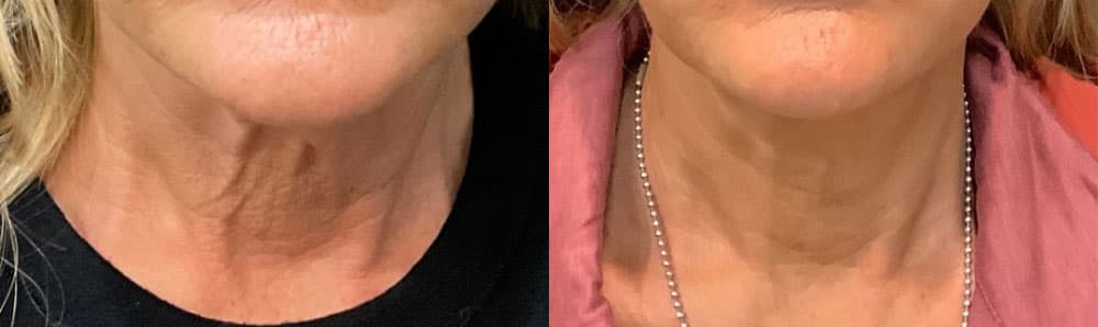 Sofwave™ before and after — Patient 6 — Dr. Anita Patel, MD, FACS, Beverly Hills