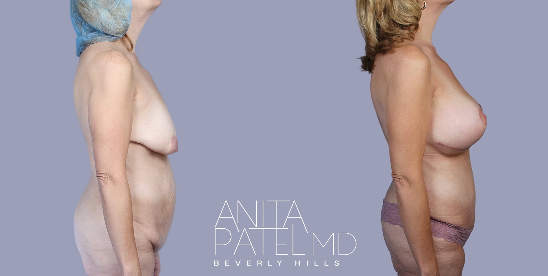 Mommy Makeover before and after — Patient 10, photo 5 of 5 — Dr. Anita Patel, MD, FACS, Beverly Hills