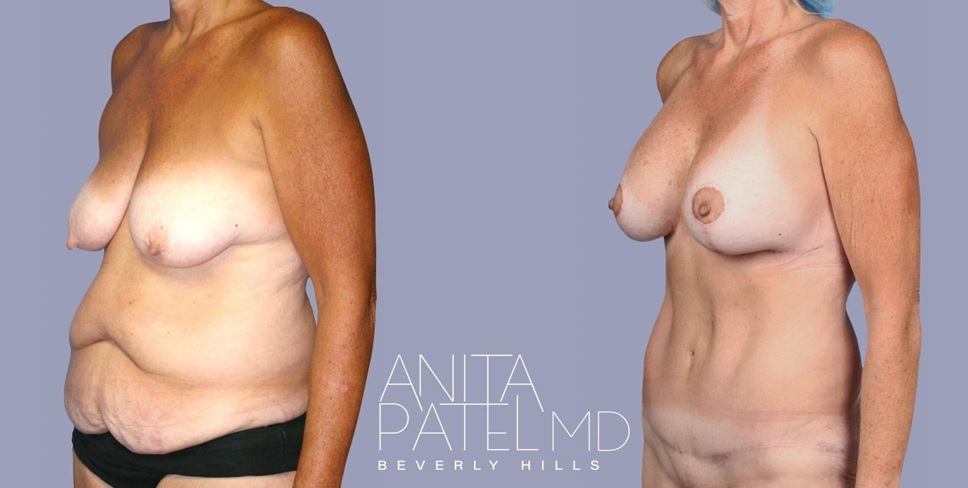 Mommy Makeover before and after — Patient 2C, photo 3 of 5 — Dr. Anita Patel, MD, FACS, Beverly Hills