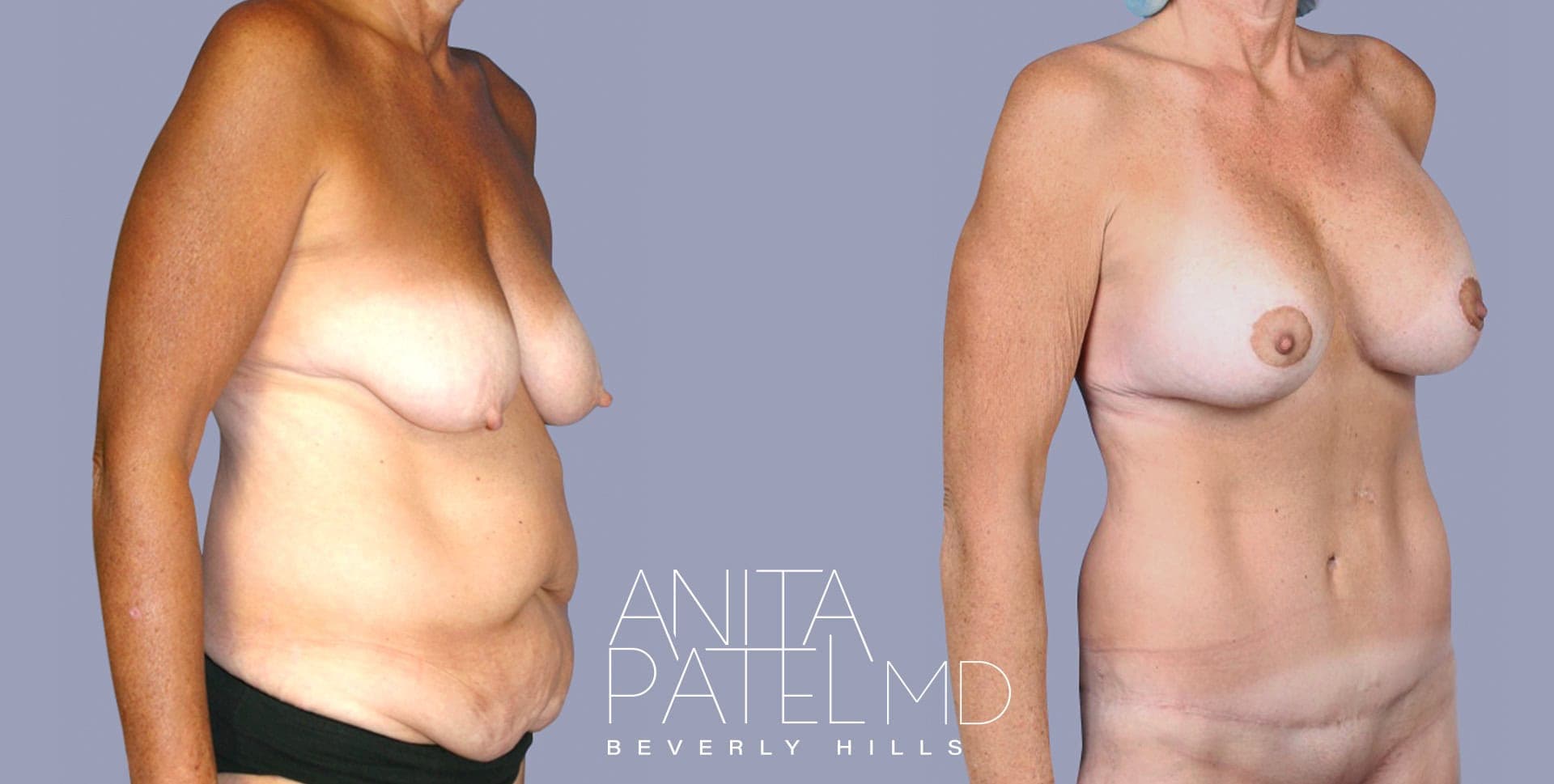 Mommy Makeover before and after — Patient 2C, photo 5 of 5 — Dr. Anita Patel, MD, FACS, Beverly Hills