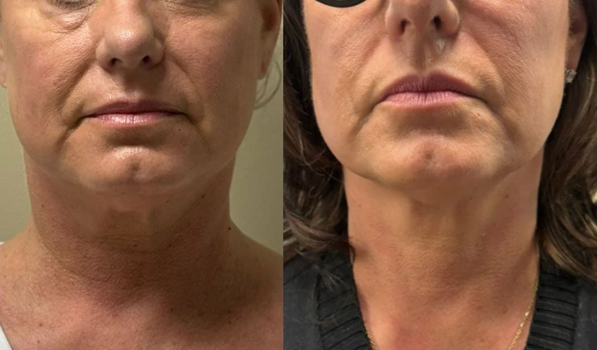 Sofwave™ before and after — Patient 5 — Dr. Anita Patel, MD, FACS, Beverly Hills
