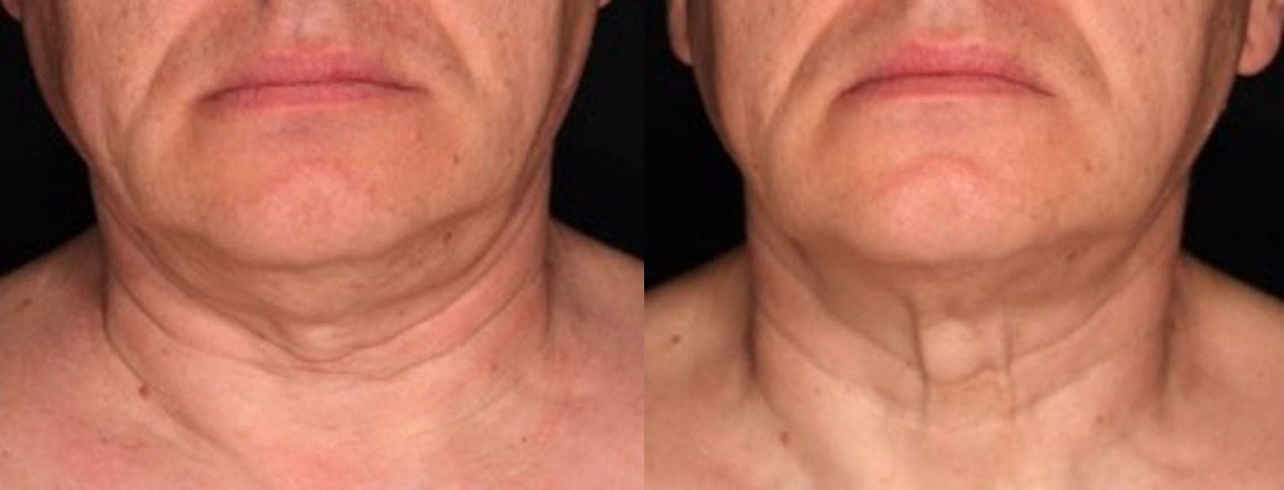Sofwave™ before and after — Patient 4 — Dr. Anita Patel, MD, FACS, Beverly Hills