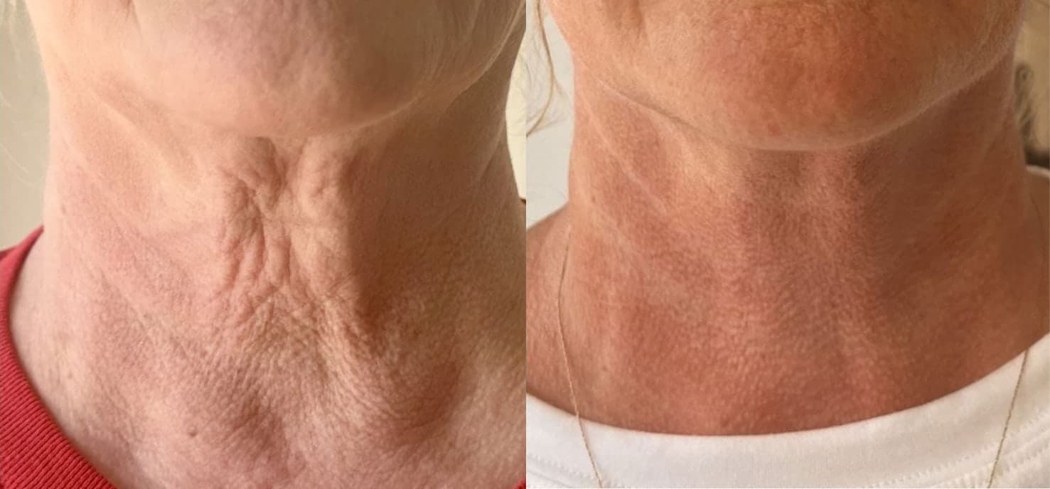 Sofwave™ before and after — Patient 3 — Dr. Anita Patel, MD, FACS, Beverly Hills