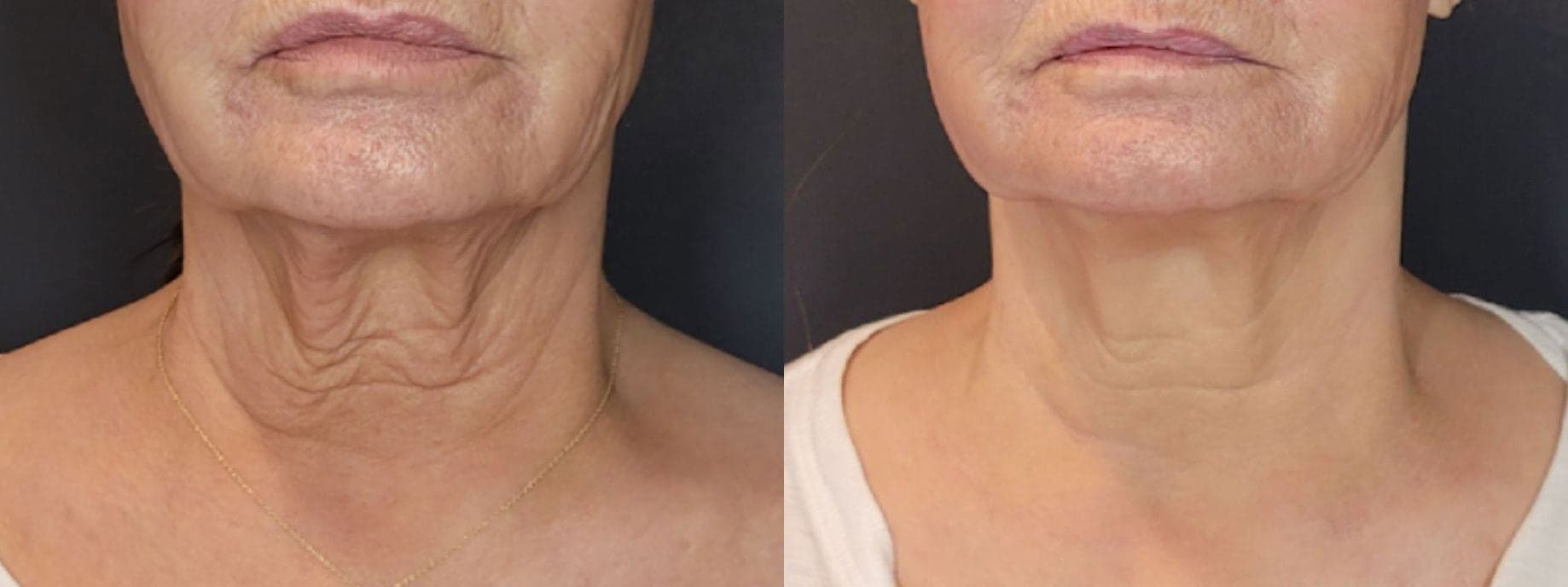 Sofwave™ before and after — Patient 2 — Dr. Anita Patel, MD, FACS, Beverly Hills
