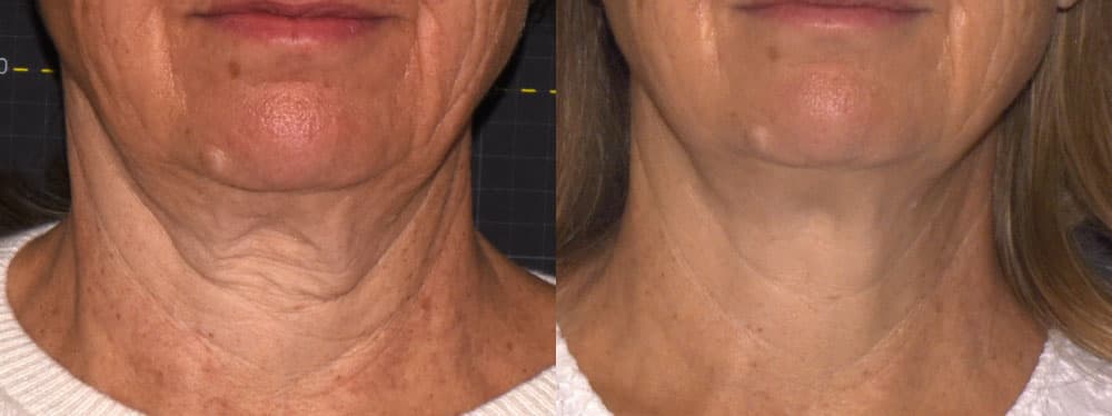 Sofwave™ before and after — Patient 12 — Dr. Anita Patel, MD, FACS, Beverly Hills