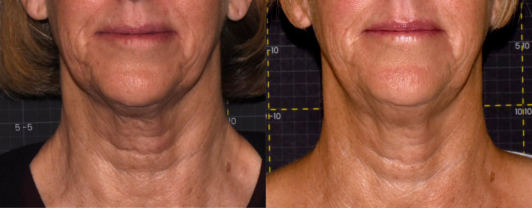 Sofwave™ before and after — Patient 11 — Dr. Anita Patel, MD, FACS, Beverly Hills