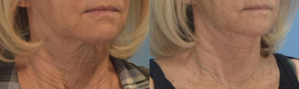 Sofwave™ before and after — Dr. Anita Patel, Beverly Hills