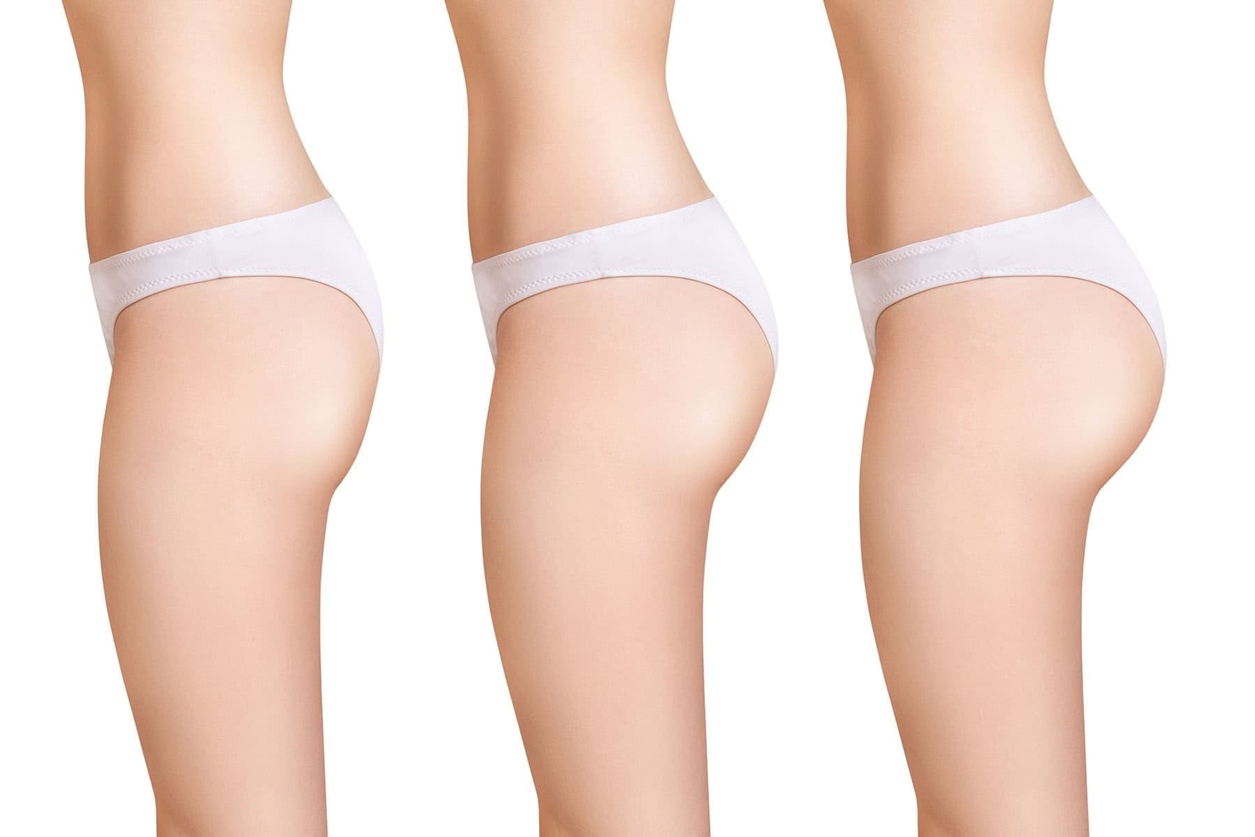 alloClae Injectable Fat Filler