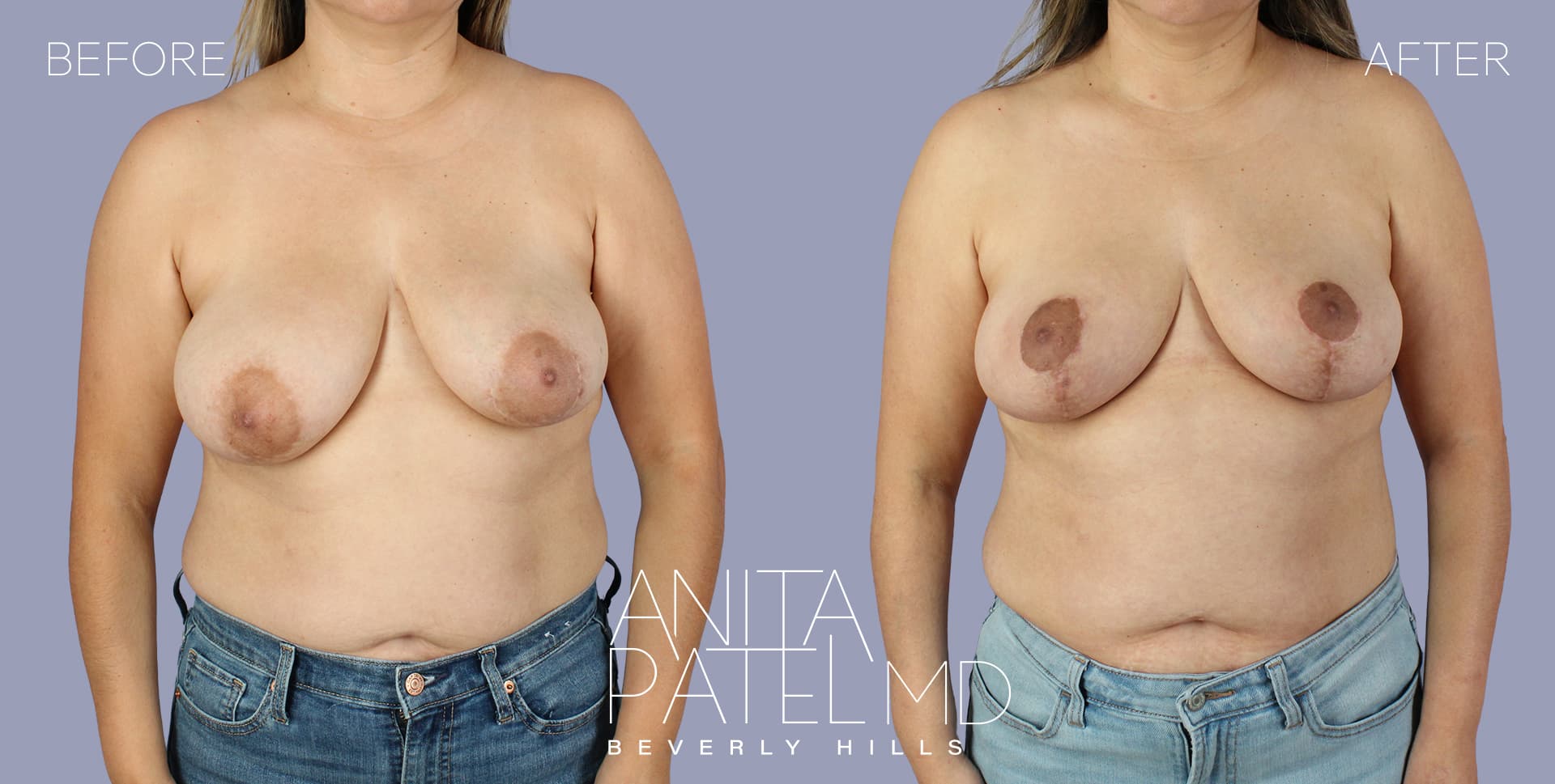 Breast Lift before and after — Patient 18, photo 1 of 5 — Dr. Anita Patel, MD, FACS, Beverly Hills