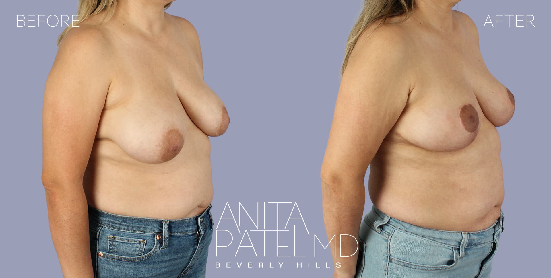Breast Lift before and after — Patient 18, photo 2 of 5 — Dr. Anita Patel, MD, FACS, Beverly Hills