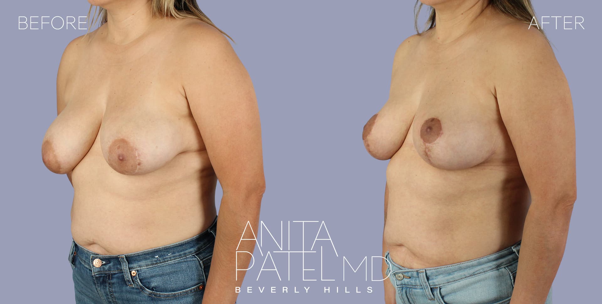 Breast Lift before and after — Patient 18, photo 4 of 5 — Dr. Anita Patel, MD, FACS, Beverly Hills