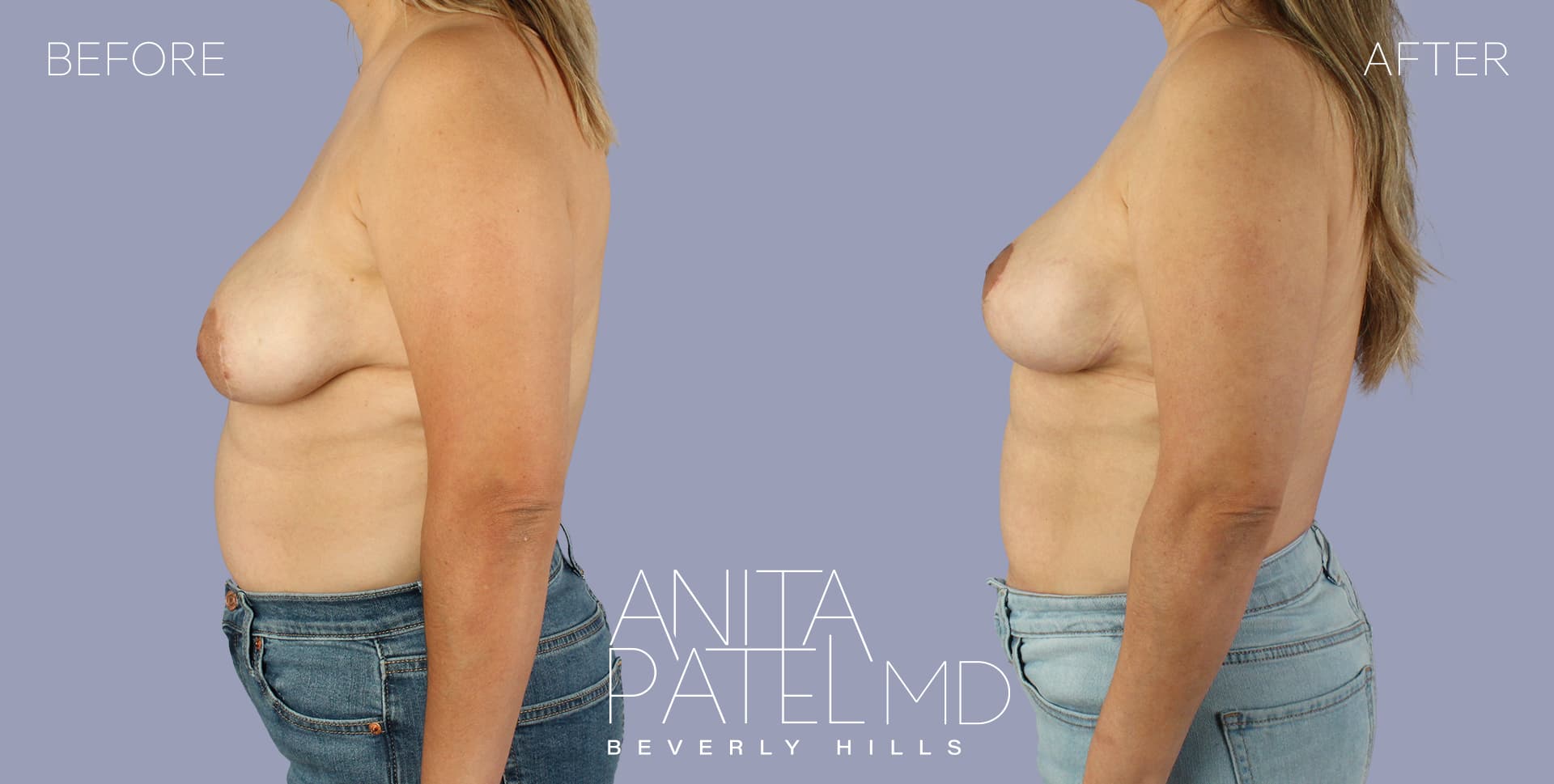 Breast Lift before and after — Patient 18, photo 5 of 5 — Dr. Anita Patel, MD, FACS, Beverly Hills
