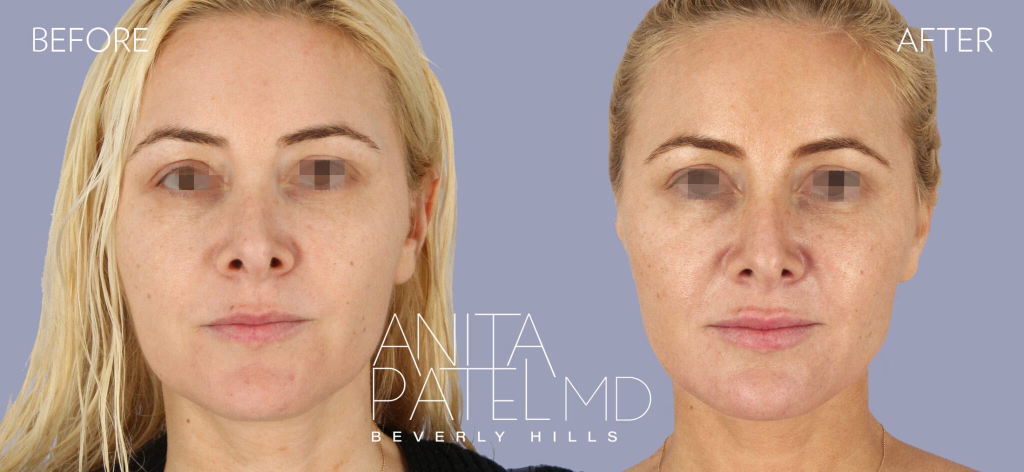 Venus RF Face Before & After Gallery Dr. Anita Patel